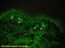 過敏性紫癜的患者，用抗IgA抗體製備的皮膚，IgA的沉積在表淺小的毛細血管(黃色箭頭)的血管壁上。在上面的淺綠色波浪區域是表皮 (皮膚)，底部纖維區域是真皮