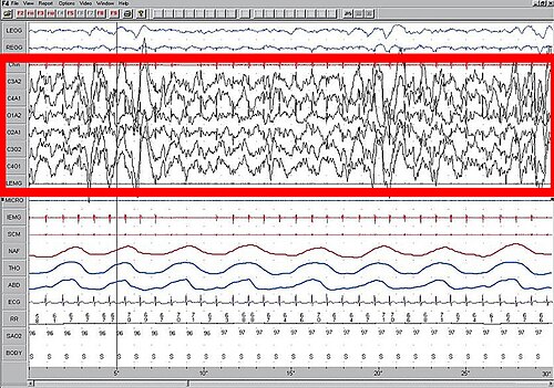 第四期睡眠。腦電圖（EEG）以紅框凸顯。