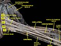 Brachial plexus.Deep dissection.Anterolateral view