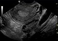 多囊卵巢在陰道超聲波檢查上顯示的圖樣