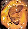 盲肠的直腸鏡（英语：Colonoscopy）影像，前面箭頭部份即為迴盲瓣