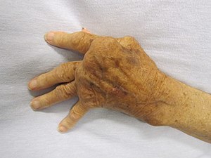晚期類風濕關節炎的老人手部照片