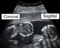 15周同卵双胞胎的冠状面与矢状面